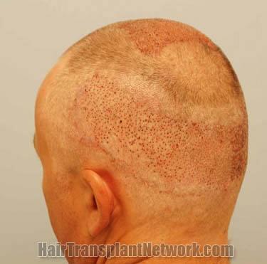 Hair transplantation surgery before and after pictures