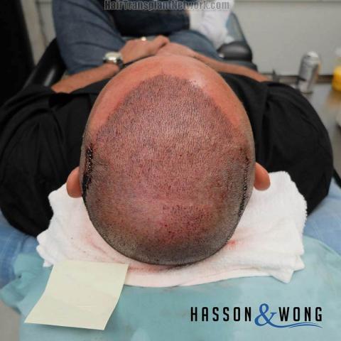 Hair transplantation surgery before and after pictures