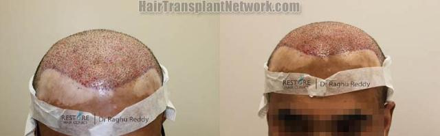 Hair transplantation surgery before and after pictures