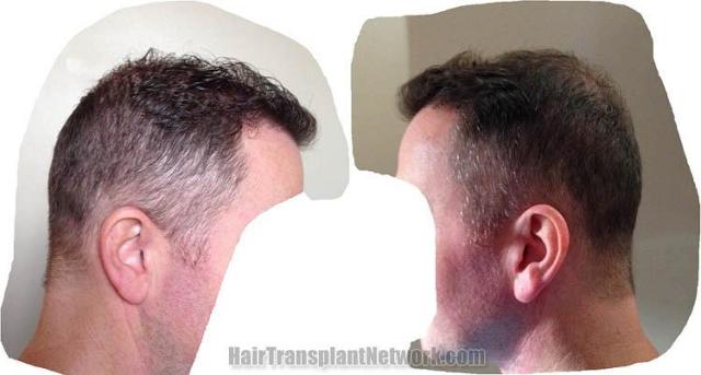 Hair transplantation surgery before and after pictures