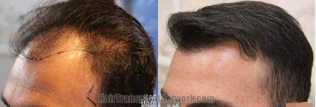 Hair transplantation surgery before and after images