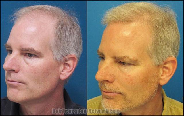 Hair restoration procedure before and after pictures