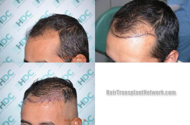 Hair transplantation surgery before and after pictures