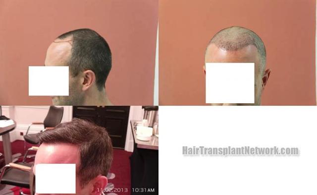 Hair restoration procedure before and after pictures