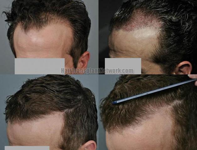 Hair transplantation surgery before and after pictures