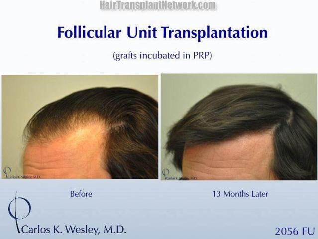 Hair transplantation surgery before and after pictures