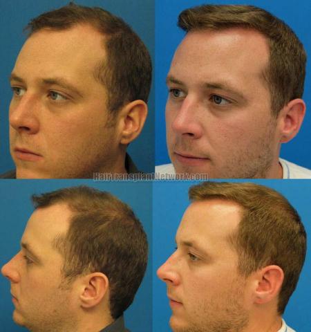 Surgical hair transplantation result photographs