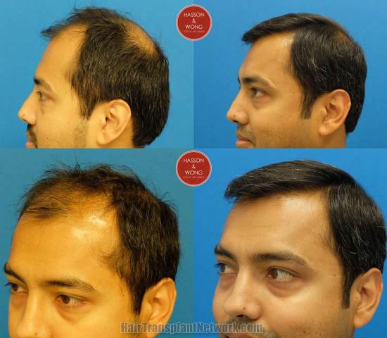 Hair transplantation surgery before and after pictures