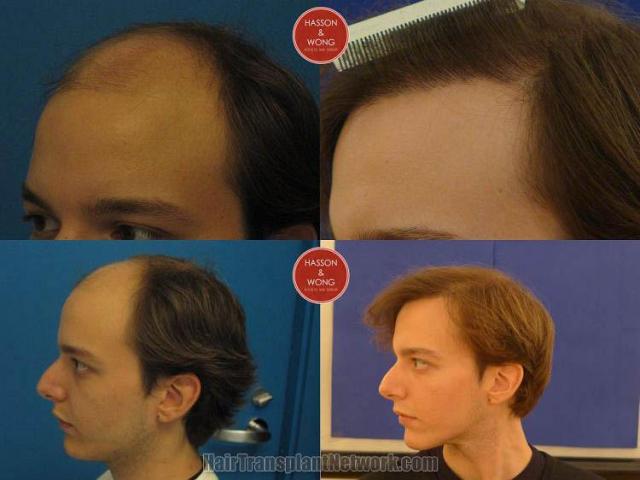 Hair transplantation surgery before and after images