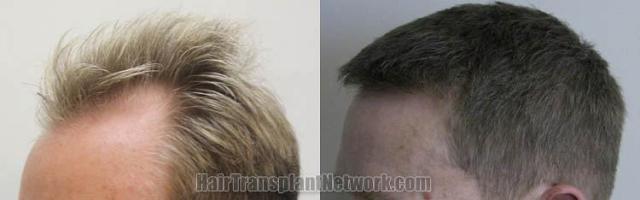 Hair transplantation surgery before and after pictures