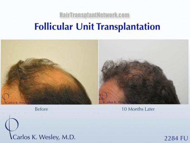 Hair transplantation surgery before and after photos