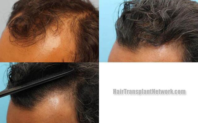 Hair transplantation surgery before and after pictures