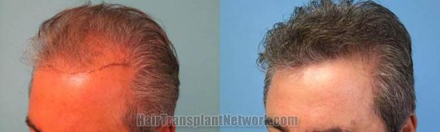 Hair restoration procedure before and after pictures