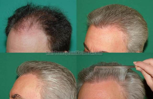 Hair transplantation surgery before and after pictures