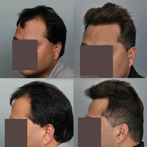 Hair restoration procedure before and after pictures