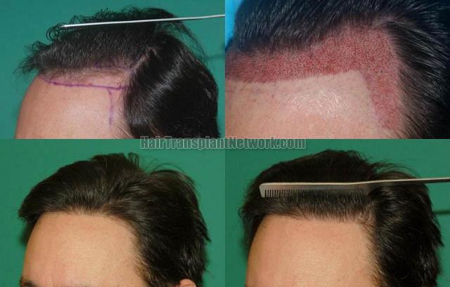 Hair transplantation surgery before and after pictures