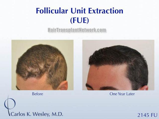 Hair transplantation surgery before and after images