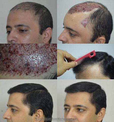 Hair transplantation surgery before and after pictures