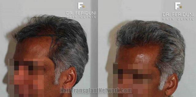 Hair transplant surgery results images left oblique view