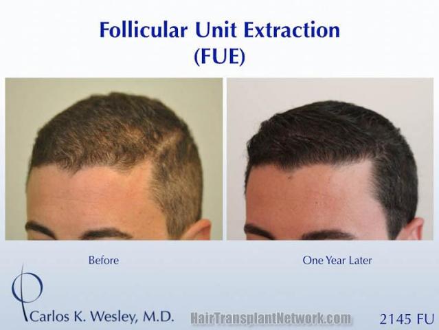 Hair transplant surgery before and after photos