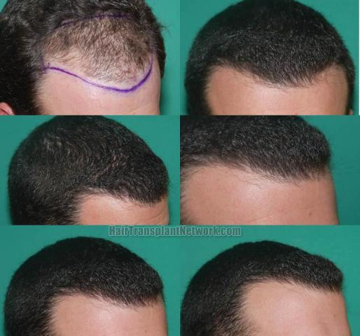 Before and after hair transplant procedure images