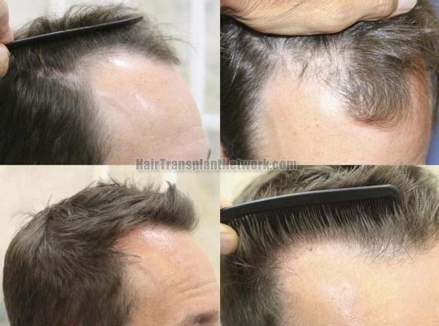 Hair transplantation surgery before and after photos