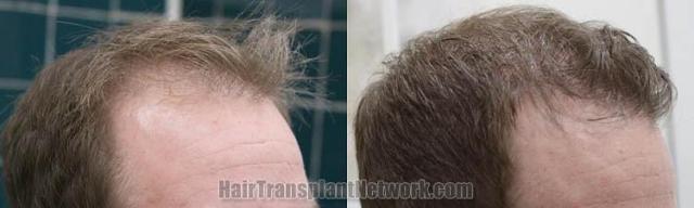 Hair transplantation surgery before and after photos