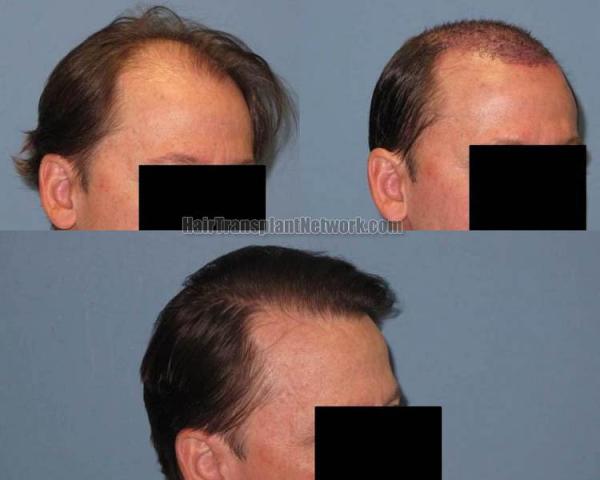 Hair transplantation surgery before and after images