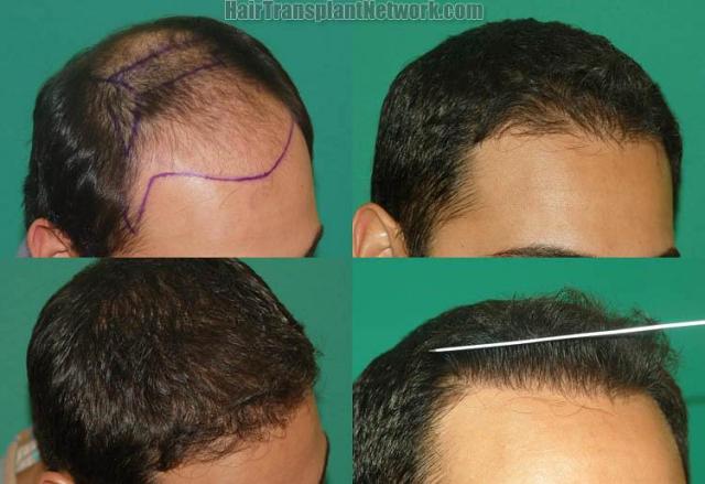 Hair transplantation surgery before and after images