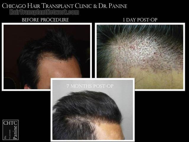 Hair transplantation surgery before and after photos