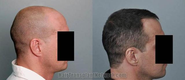 Hair transplantation surgery before and after images