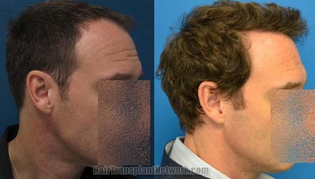 Hair transplantation surgery before and after pictures