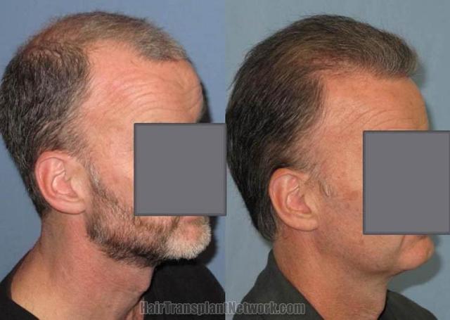 Hair transplantation surgery before and after images