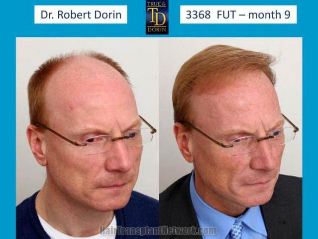 Hair restoration procedure before and after results