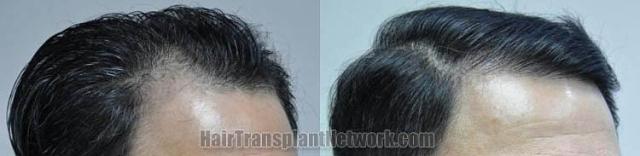 Hair transplantation surgery before and after images