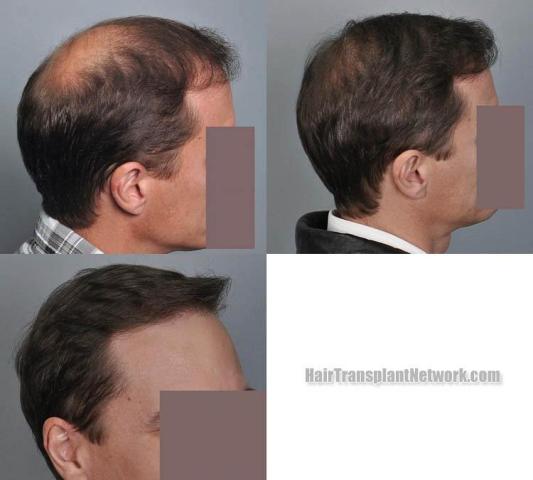 Hair restoration procedure before and after results