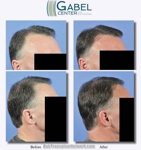 Hair transplantation surgery before and after images