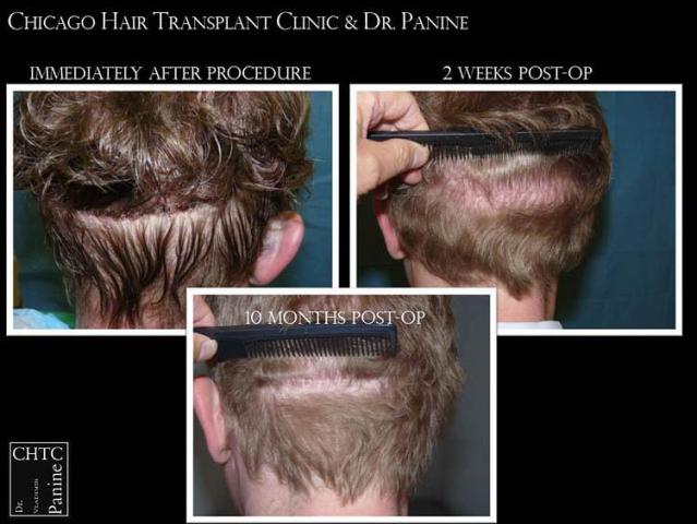 Hair restoration procedure before and after pictures