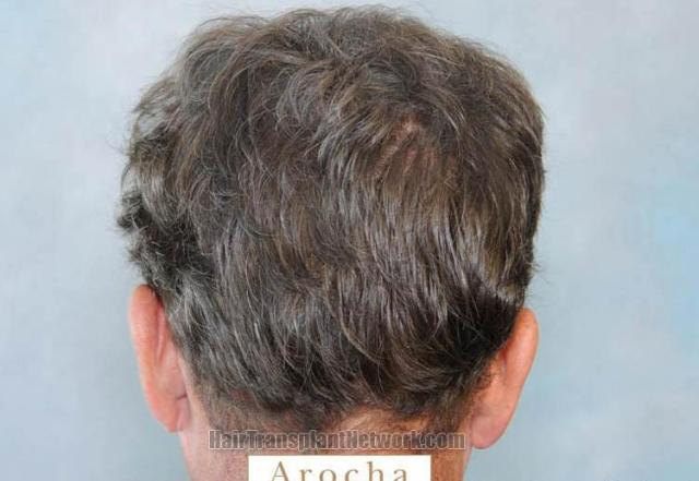 Hair restoration procedure before and after pictures