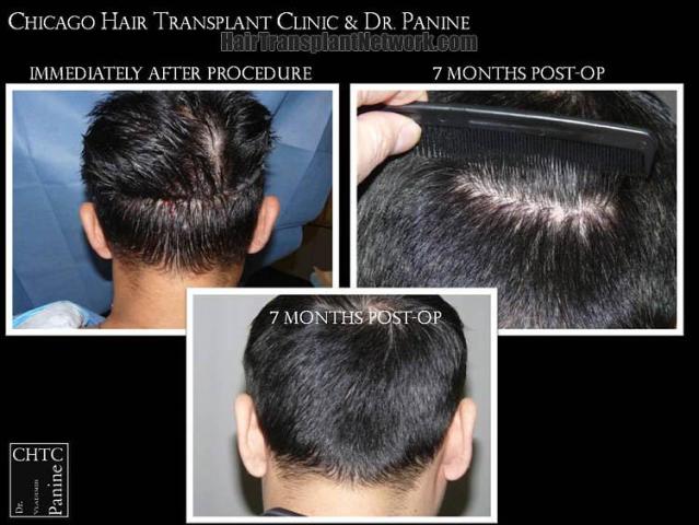 Hair restoration procedure before and after pictures