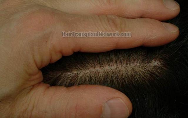 Hair transplantation surgery before and after pictures