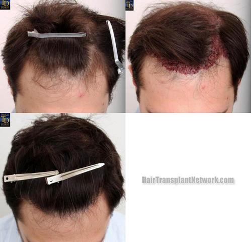 Hair restoration procedure before and after pictures