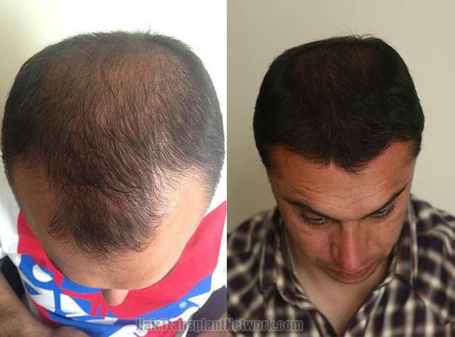 Hair transplantation surgery before and after photos