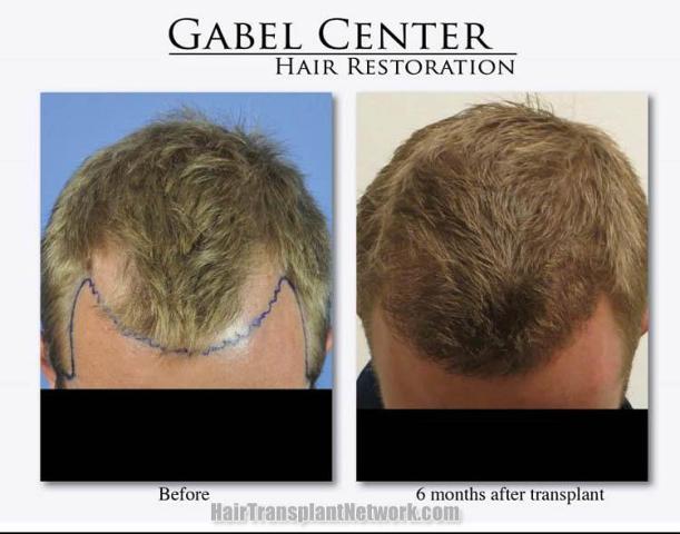 Hair transplantation surgery before and after photos