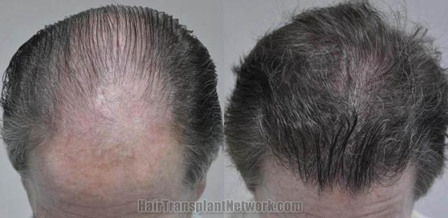 Hair transplantation surgery before and after photos