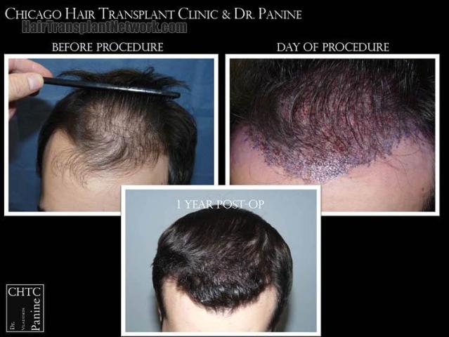 Hair transplantation surgery before and after images