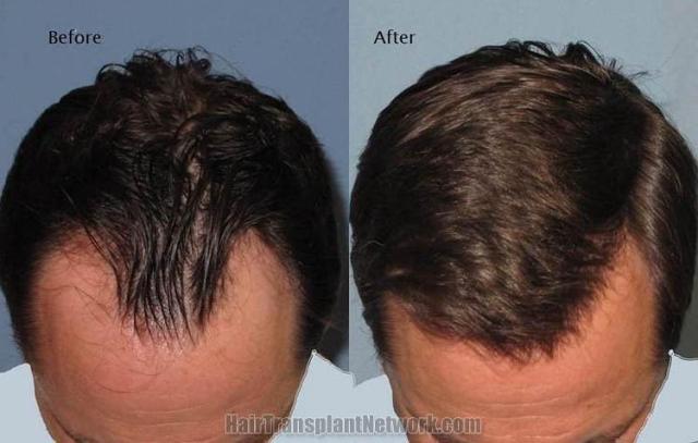 Hair transplantation surgery before and after photos