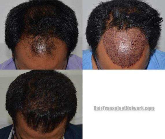 Hair transplantation surgery before and after photos