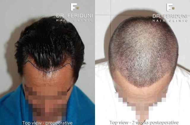 Top view before and after hair restoration results