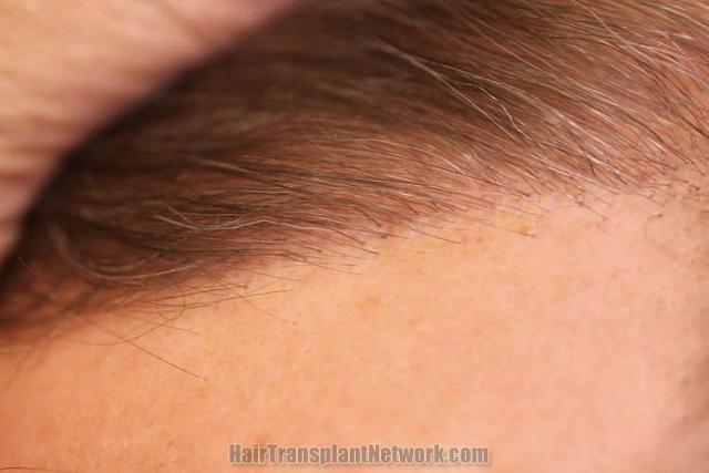 Hair restoration procedure before and after pictures